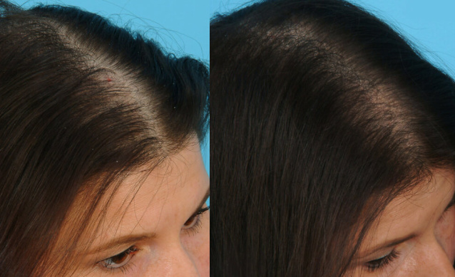 Результат плазмолифтинга