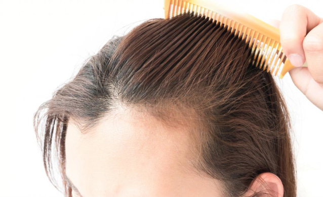 Выпадение волос